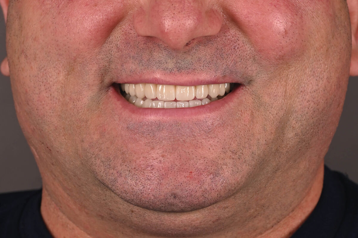 Zâmbet lateral stanga_dupa